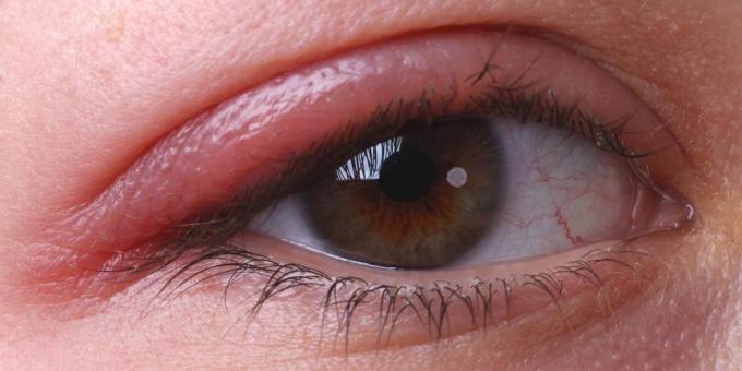 Zakaj srbeče oči: blefaritis