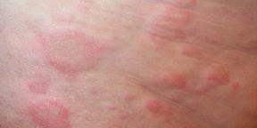 Alergije na otroka: vse, kar starši morali vedeti o diagnostiki in zdravljenju