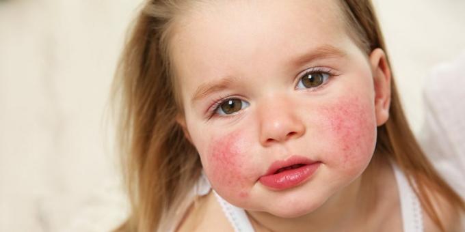 Izpuščaji na obrazu: alergija na hrano