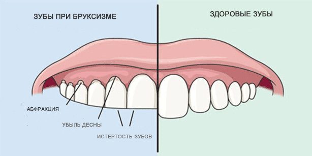 Škrtanje z zobmi: zdrave zobe in zobe med bruksizem