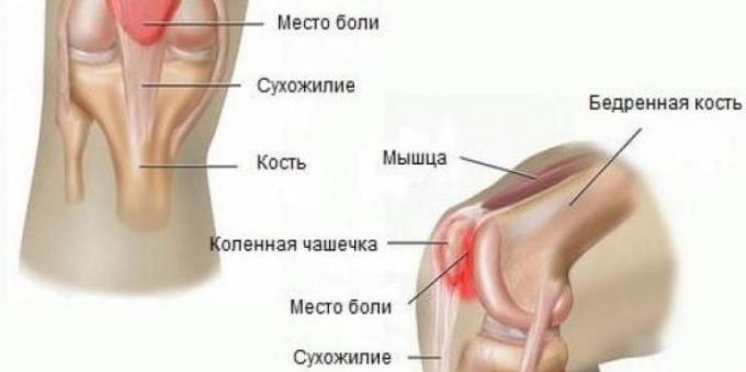 Zakaj bolijo kolena: sindrom patellofemoral bolečina