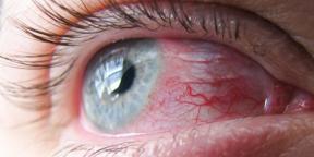 Konjunktivitis: zakaj Ocrveniti oči in kako jih zdraviti
