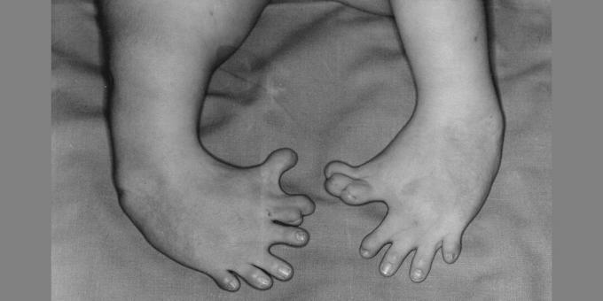 Deformacija nog novorojenčka, katerega mati je jemala talidomid. Neželeni učinki zdravila se imenujejo primer delovanja Big Pharma.