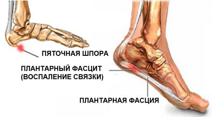 plantarna fasciitis