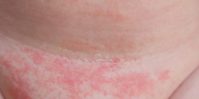 Dermatomikoza: kožna kandidoza