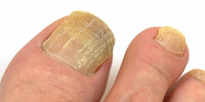 Dermatomikoza: glivice na nohtih