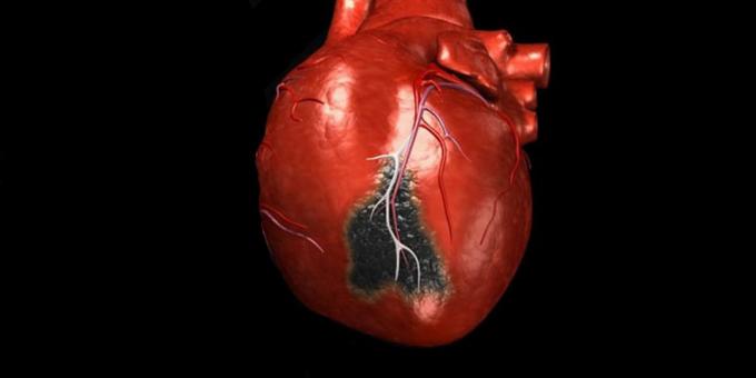Simptomi srčnega napada, za katerega boste morali poklicati rešilca