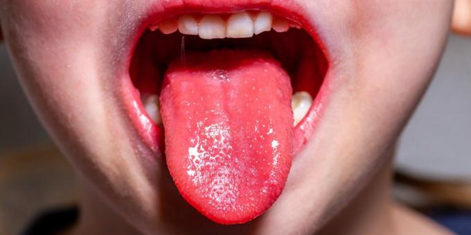 Simptomi škrlatne vročine: jagodni jezik
