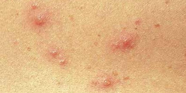 Simptomi norice pri otrocih in odraslih: Pogosto je koža takoj pojavijo majhne rdeče pike
