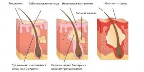 Kako se znebiti Acne: najbolj celovit vodnik