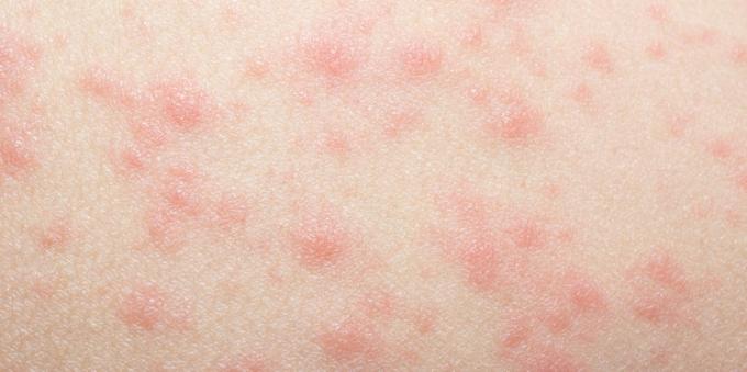 Kožni izpuščaj z alergijami na zdravila